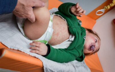 Sarampión en niños: señales de alerta y qué hacer